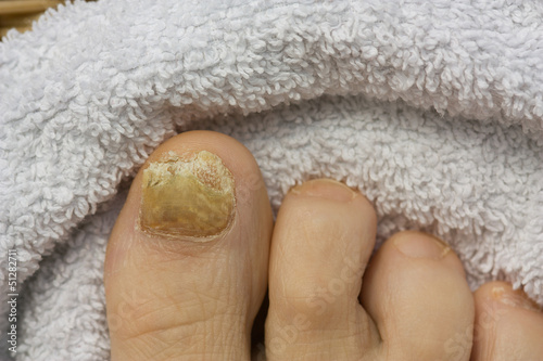 Nagelpilz
