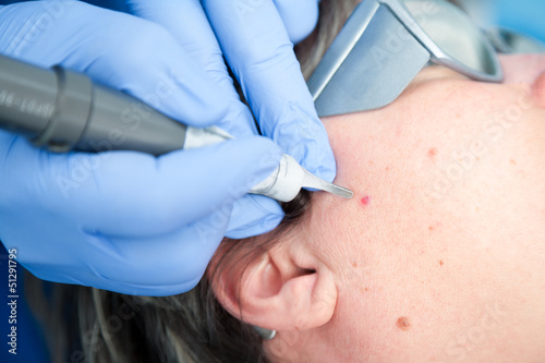 Leberfleck Laser Kosmetik