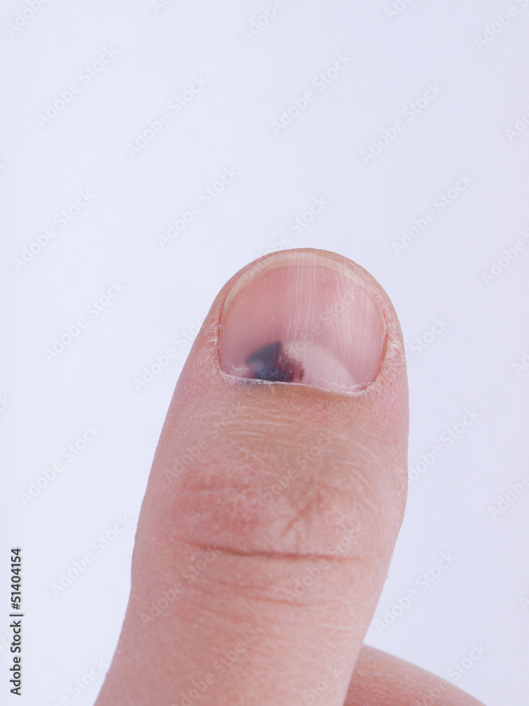 Subungual hematoma under nail Stock Photo Adobe Stock