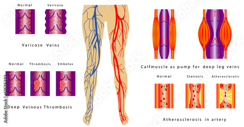 Vascular System Legs