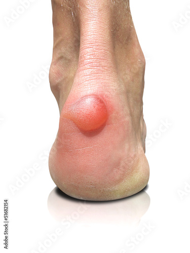 Slika na platnu Blister on human heel