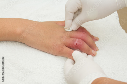 Foto Hand Injury  after car accident severed  closed fracture 2-4 fin
