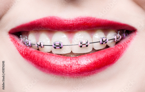 Teeth with braces
