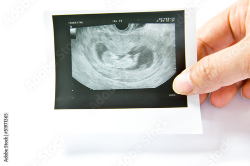 12 weeks baby ultrasound Image