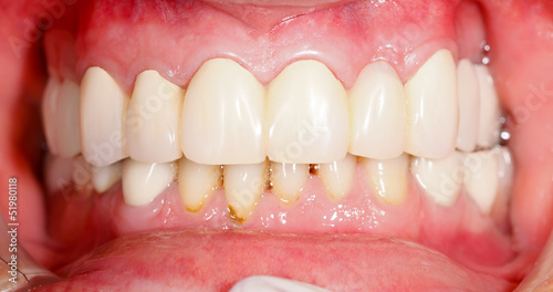 Dental Prosthetics