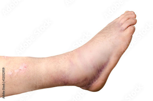 Photo Broken ankle of a person isolated on white background