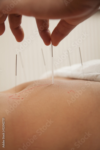 Inserting Acupuncture Needles