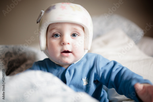 baby with elment for  Plagiocephaly