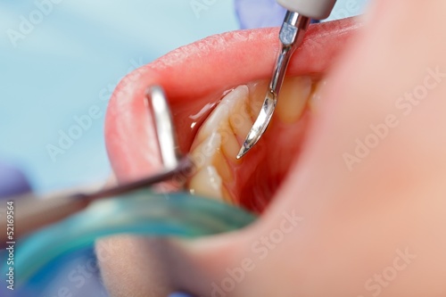 Dental calculus removing photo