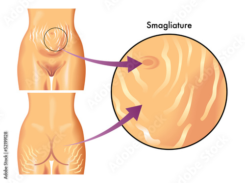 smagliature