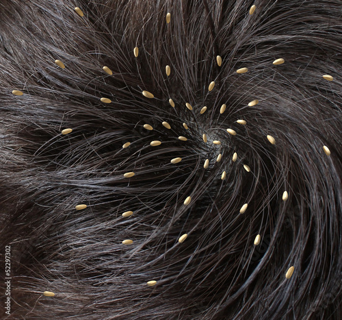 Head Lice photo