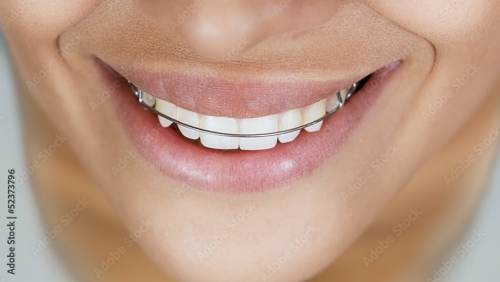 Obraz premium Beautiful smiling girl with retainer for teeth
