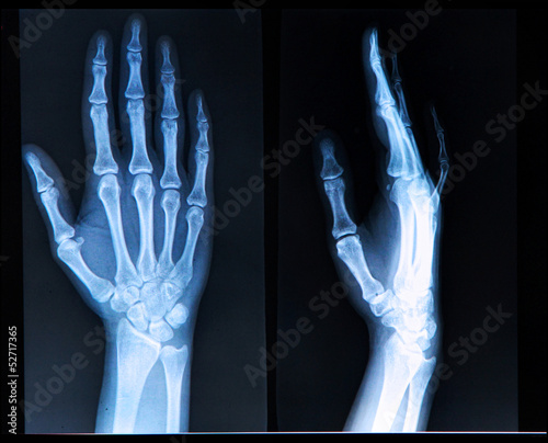 Quadro su tela Xray of Hand/ fingers