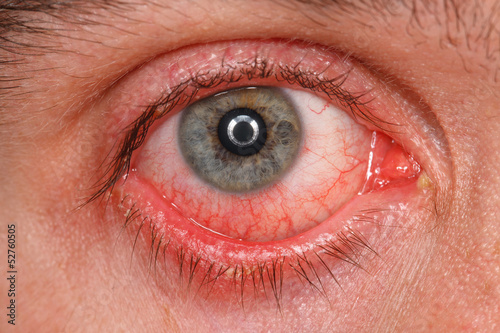 Chronic conjunctivitis eye with red iris and pus close-up. photo