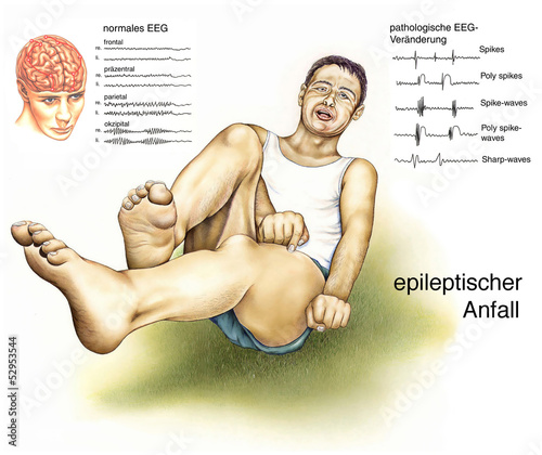 Epilepsie.EEG.Krampf-Anfall