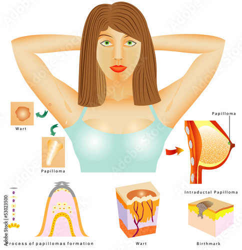 Human papilloma virus (HPV)