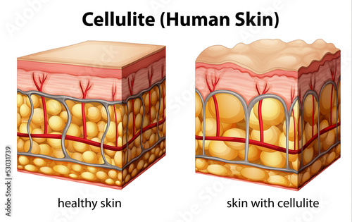 Cellulite