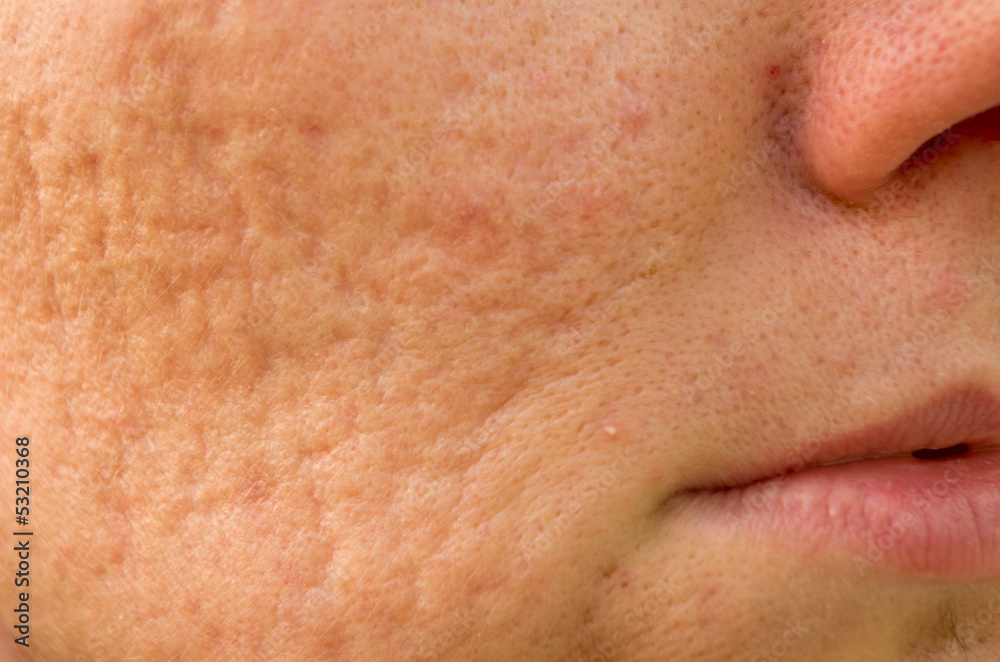 problematic skin with acne scars problematic skin with acne scars