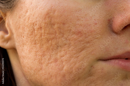 Obraz na płótnie acne scars
