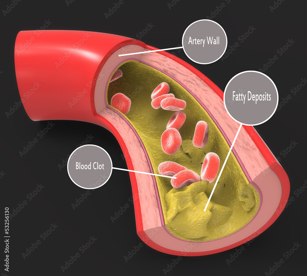 Diseased artery with fatty deposits