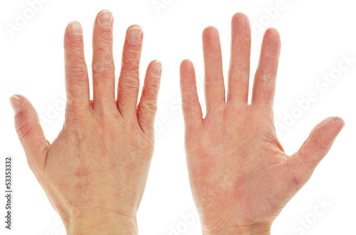 Eczema Dermatitis on Front and Back of Pair of Hands