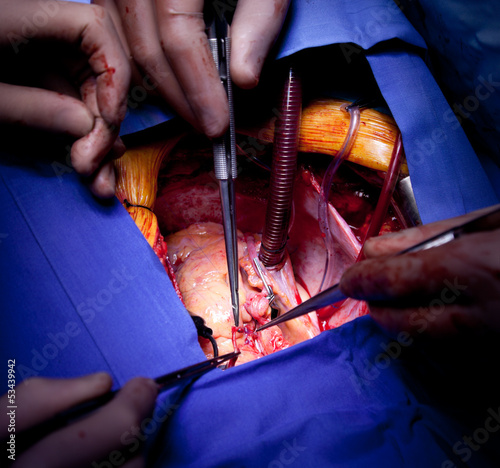 Cardiac surgery heart operation