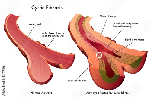 fibrosi cistica
