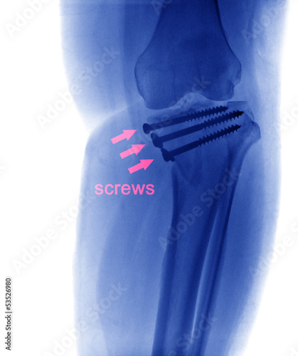 x ray of fractures bone