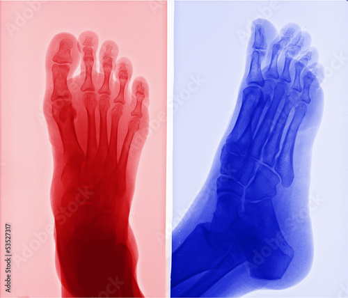 Photography X-ray picture of foot