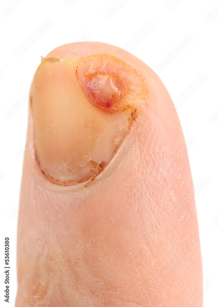 Fototapeta premium Finger cut with knife, not imitated, ten days after unjury