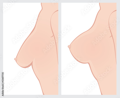 Breast Uplift before and after surgery