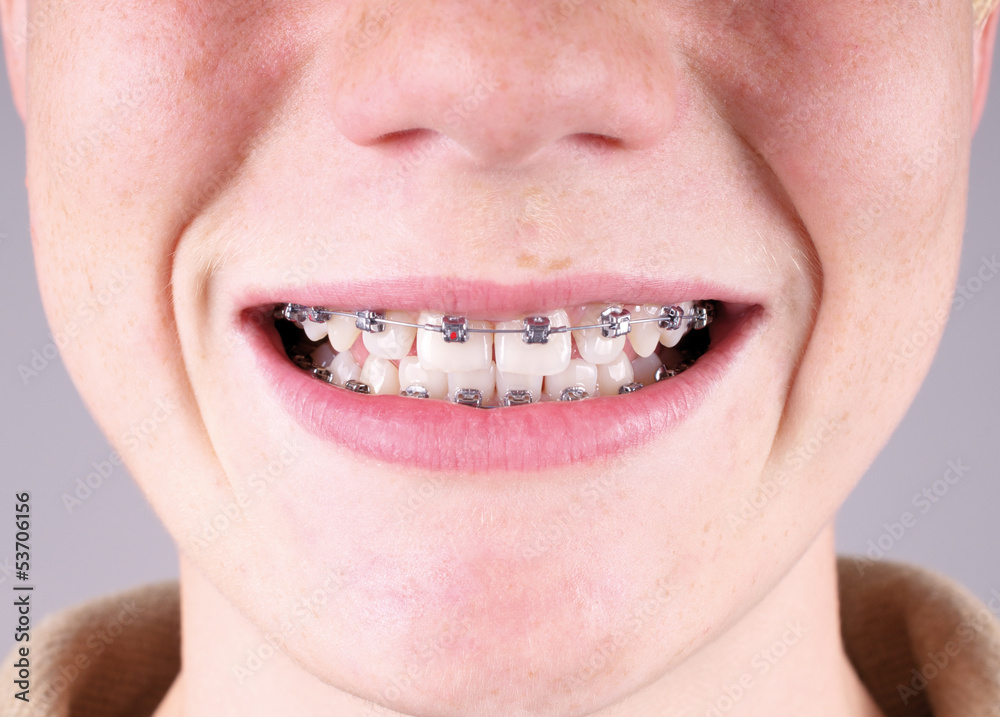 Fototapeta premium Zahnspange