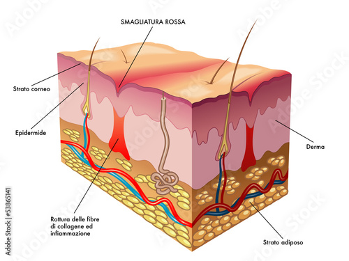 smagliatura rossa