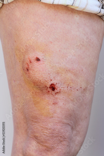 Accident, dog bite, puncture wound on human leg