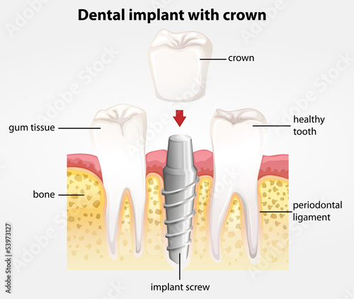 Dental implant with crown photo