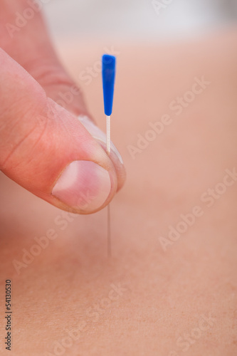 An Acupuncture Therapy In A Spa Center
