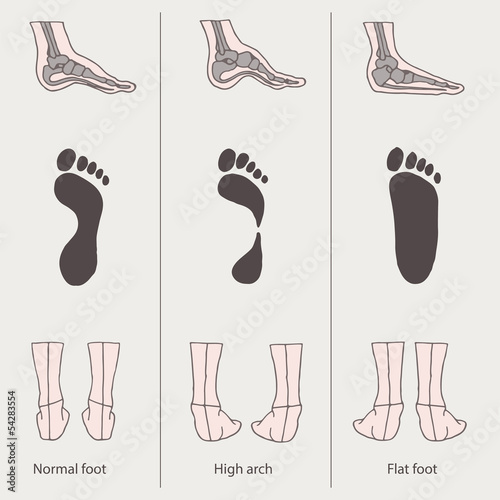 set of flat foot, high arch