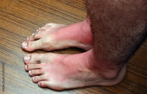 Sunburn feets