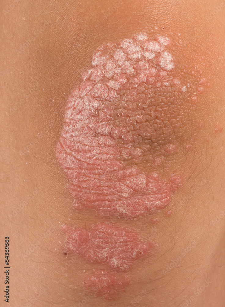 Fototapeta premium psoriasis