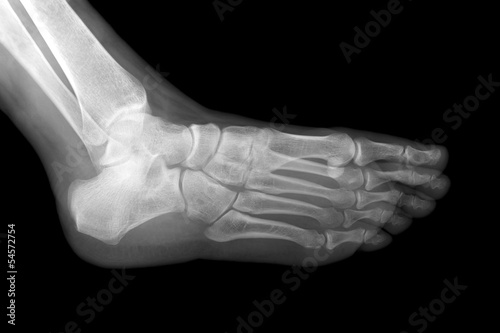 Left foot x-ray