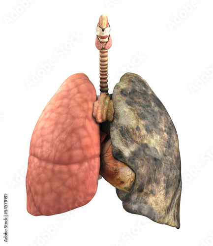 Lung Disease Before and After