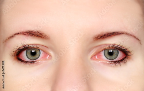 Closeup of irritated red bloodshot eye photo