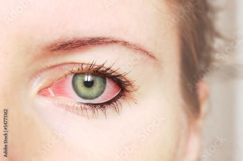Foto Closeup of irritated red bloodshot eye