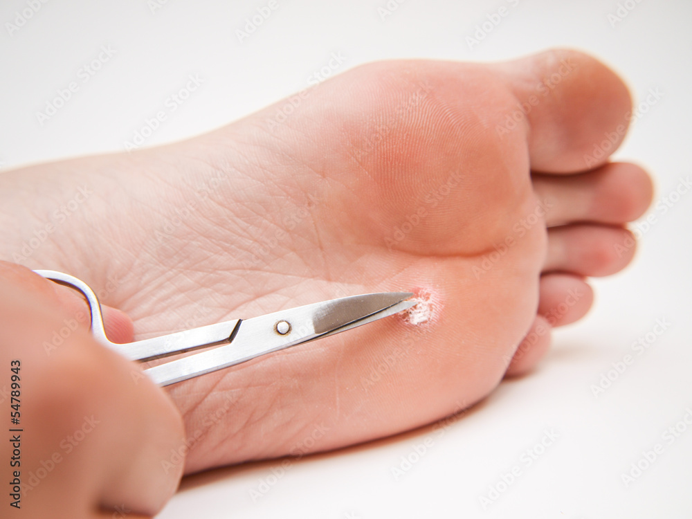 Callus under foot, treated with a pair of scissors Callus under foot, treated with a pair of scissors