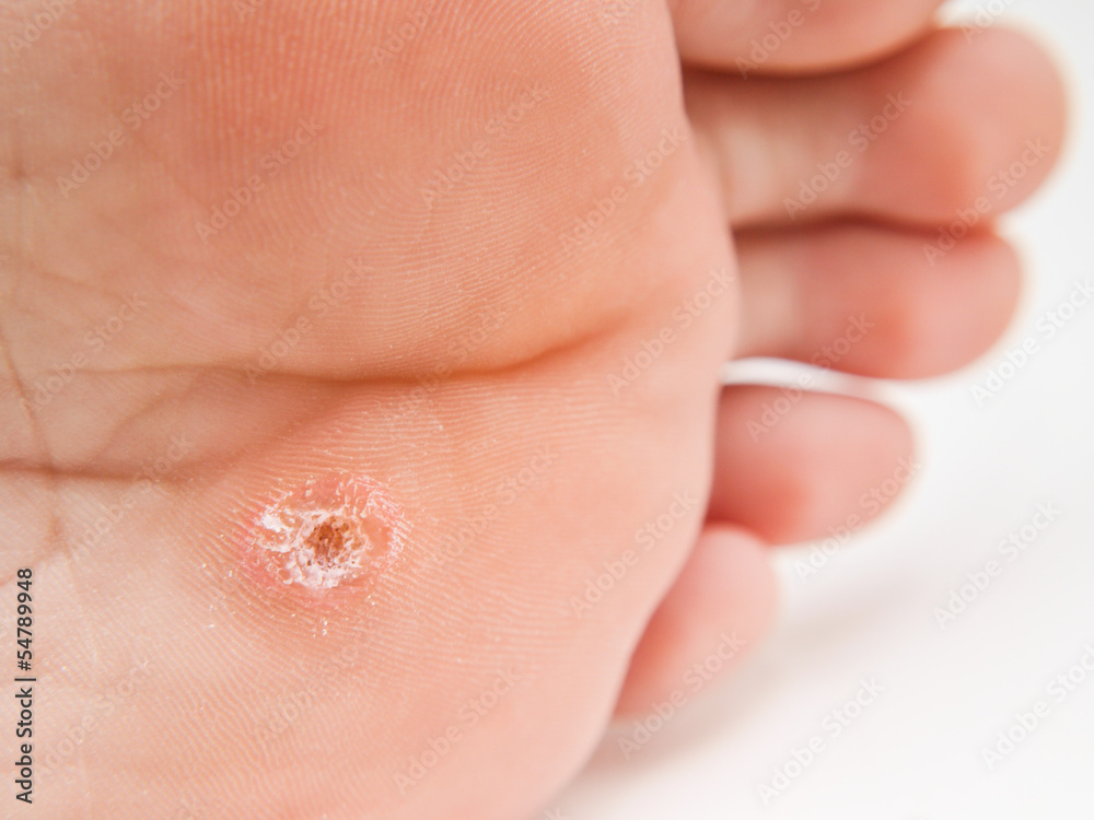 Fototapeta premium Callus under foot