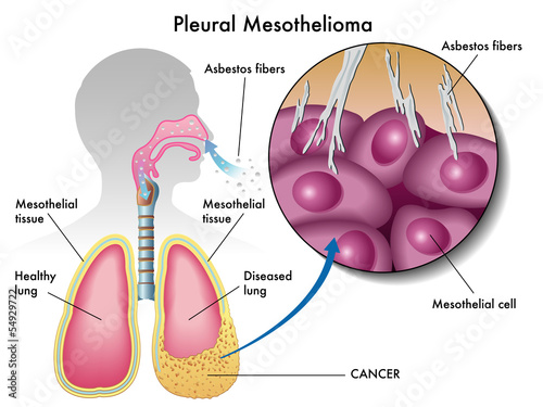 mesotelioma pleurico