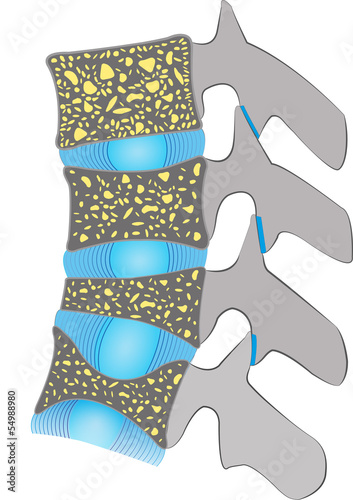 Osteoporose - Wirbelkörper