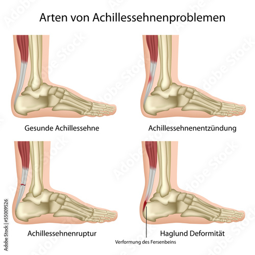 Probleme der Achillessehne