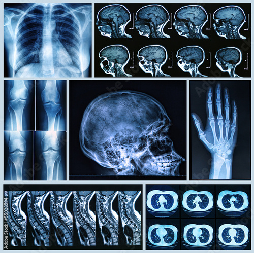 Radiography of Human Bones