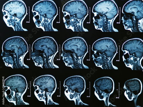 MRI Brain Scan